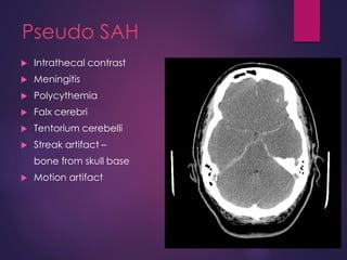 Pseudo SAH
 Intrathecal contrast
 Meningitis
 Polycythemia
 Falx cerebri
 Tentorium cerebelli
 Streak artifact –
bone from skull base
 Motion artifact
 