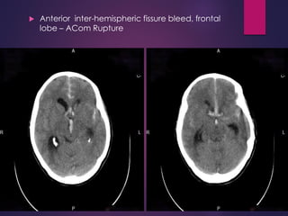  Anterior inter-hemispheric fissure bleed, frontal
lobe – ACom Rupture
 
