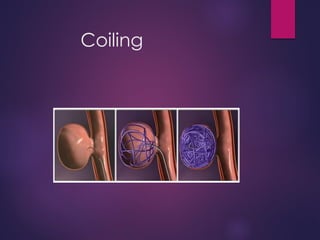 Coiling
 