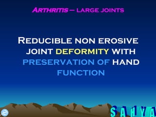 Arthritis  – large joints Reducible non erosive joint  deformity  with  preservation of  hand  function 