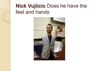 Nick Vujiicic Does he have the
feet and hands

 