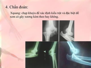 4. Chẩn đoán:
Xquang: chụp khuỷu để xác định kiểu trật và đặc biệt để
xem có gãy xương kèm theo hay không.
 