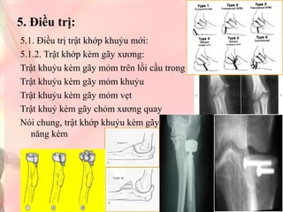 5. Điều trị:
5.1. Điều trị trật khớp khuỷu mới:
5.1.2. Trật khớp kèm gãy xương:
Trật khuỷu kèm gãy mỏm trên lồi cầu trong
Trật khuỷu kèm gãy mỏm khuỷu
Trật khuỷu kèm gãy mỏm vẹt
Trật khuỷ kèm gãy chỏm xương quay
Nói chung, trật khớp khuỷu kèm gãy chỏm quay, kết quả cơ
năng kém
 