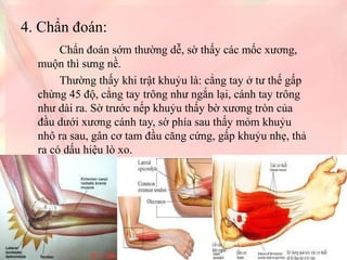 4. Chẩn đoán:
Chẩn đoán sớm thường dễ, sờ thấy các mốc xương,
muộn thì sưng nề.
Thường thấy khi trật khuỷu là: cẳng tay ở tư thế gấp
chừng 45 độ, cẳng tay trông như ngắn lại, cánh tay trông
như dài ra. Sờ trước nếp khuỷu thấy bờ xương tròn của
đầu dưới xương cánh tay, sờ phía sau thấy mỏm khuỷu
nhô ra sau, gân cơ tam đầu căng cứng, gấp khuỷu nhẹ, thả
ra có dấu hiệu lò xo.
 