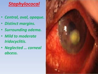Staphylococal
• Central, oval, opaque.
• Distinct margins.
• Surrounding odema.
• Mild to moderate
Iridocyclitis.
• Neglected … corneal
abcess.
 