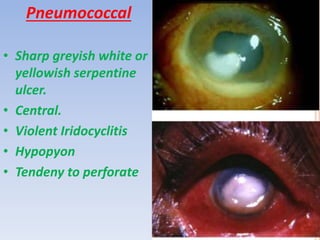 Pneumococcal
• Sharp greyish white or
yellowish serpentine
ulcer.
• Central.
• Violent Iridocyclitis
• Hypopyon
• Tendeny to perforate
 