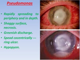 Pseudomonas
• Rapidly spreading to
periphery and in depth.
• Shaggy surface,
necrosis.
• Greenish discharge.
• Spead cocentrically ---
ring ulcer.
• Hypopyon.
 