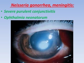 Neisseria gonorrhea, meningitis:
• Severe purulent conjunctivitis
• Ophthalmia neonatorum
 