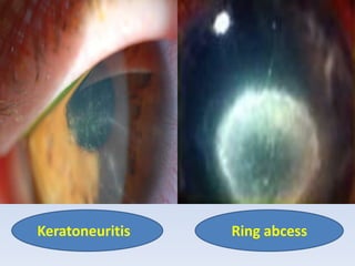 Keratoneuritis Ring abcess
 