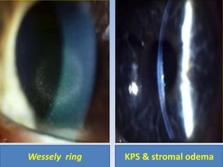 Wessely ring KPS & stromal odema
 