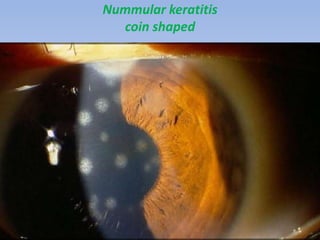Nummular keratitis
coin shaped
 
