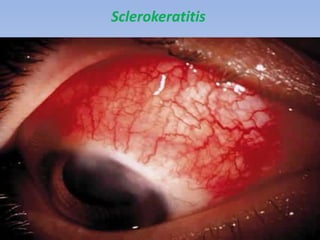 Sclerokeratitis
 
