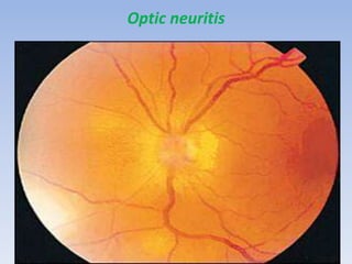Optic neuritis
 