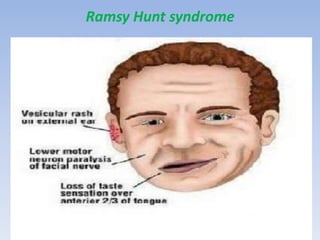 Ramsy Hunt syndrome
 