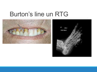 Burton’s line un RTG
 
