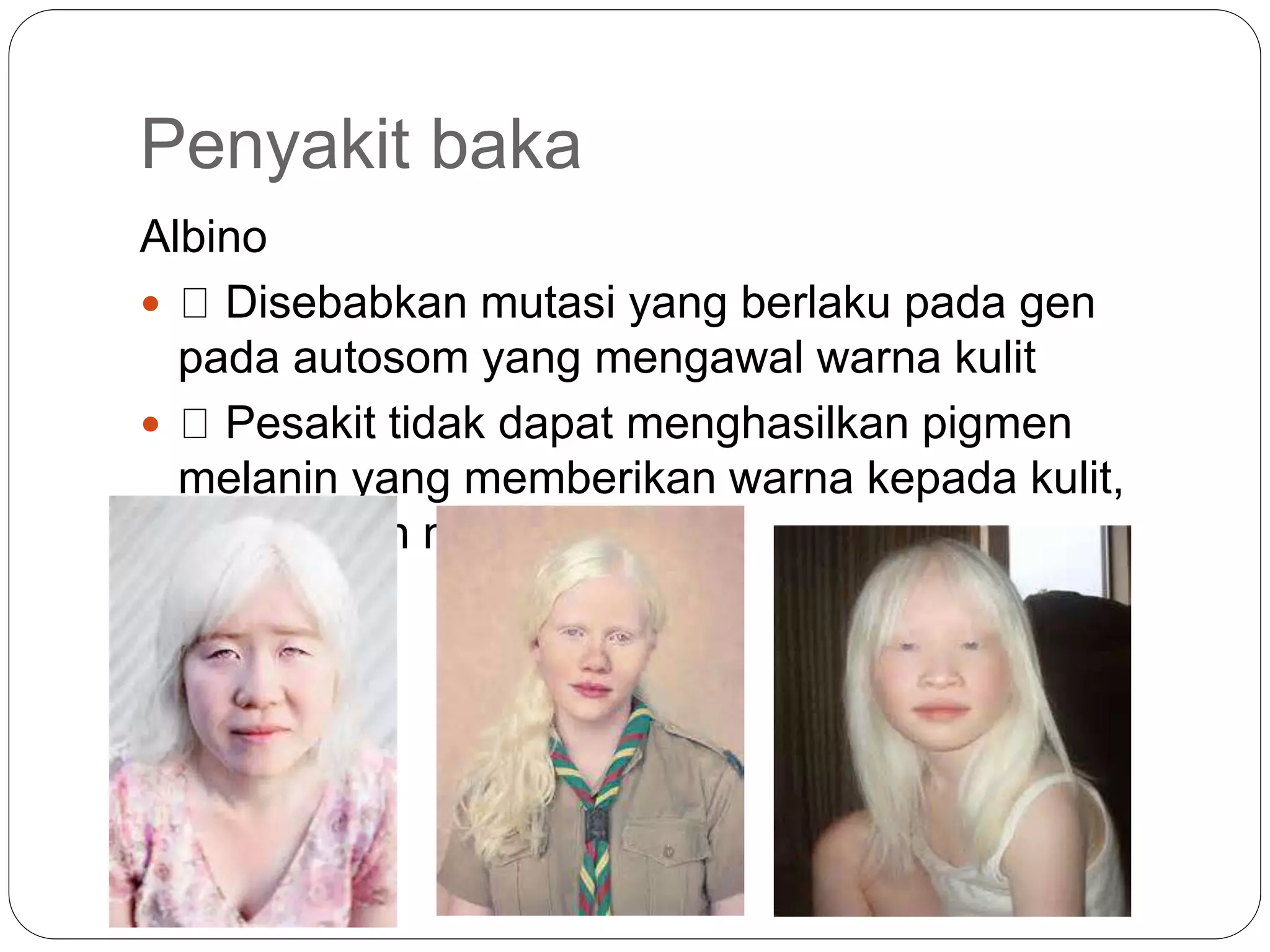 Penyakit baka
Albino
 Disebabkan mutasi yang berlaku pada gen
pada autosom yang mengawal warna kulit
 Pesakit tidak dapat menghasilkan pigmen
melanin yang memberikan warna kepada kulit,
rambut dan mata
 