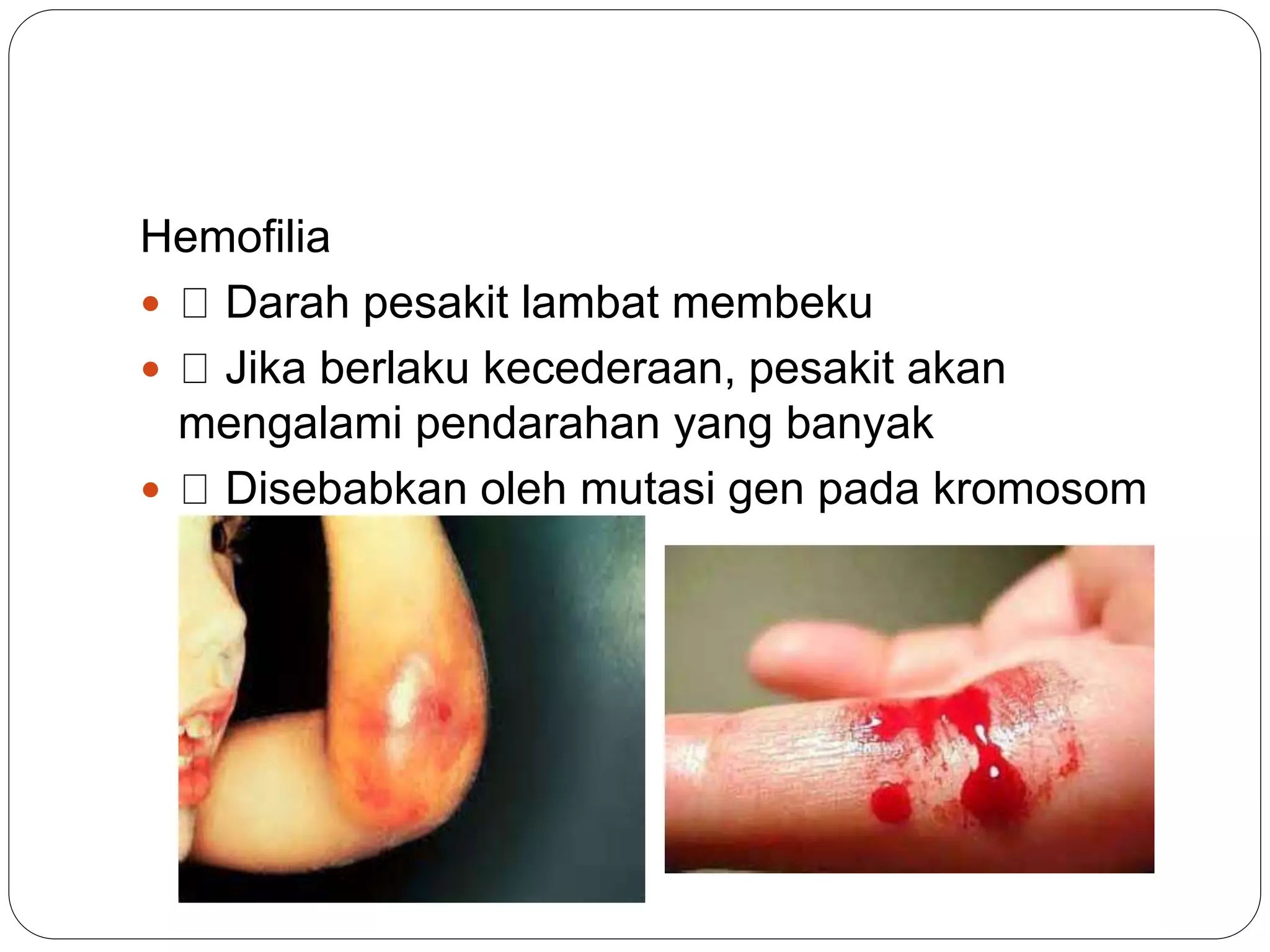 Hemofilia
 Darah pesakit lambat membeku
 Jika berlaku kecederaan, pesakit akan
mengalami pendarahan yang banyak
 Disebabkan oleh mutasi gen pada kromosom
seks X
 