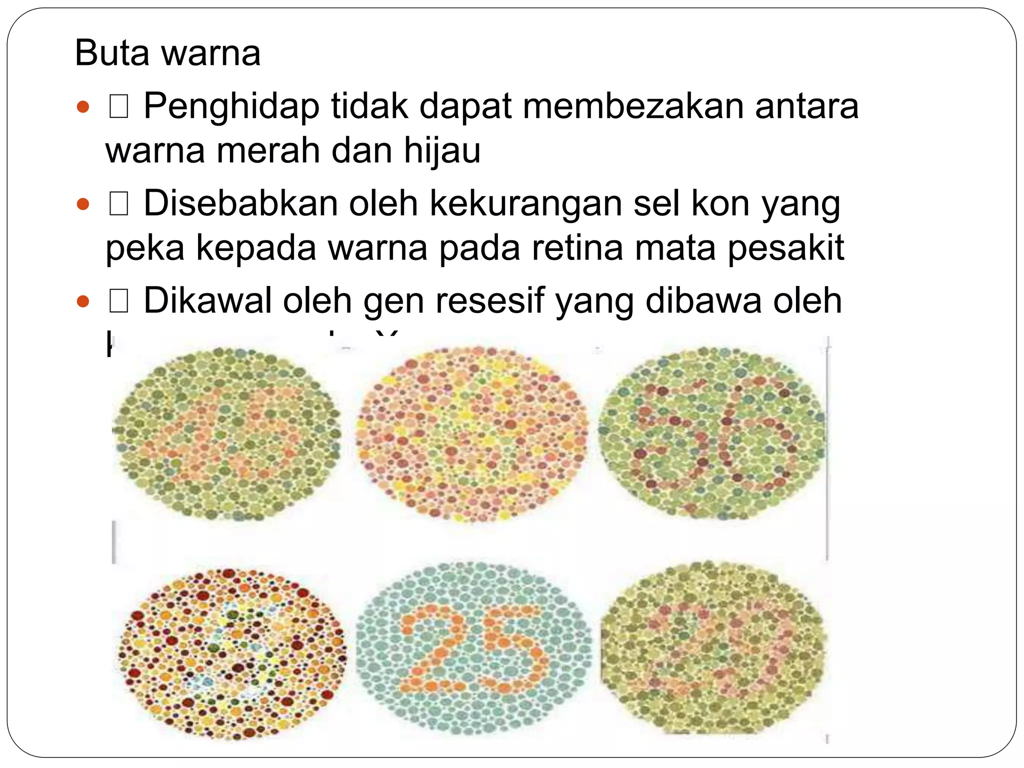 Buta warna
 Penghidap tidak dapat membezakan antara
warna merah dan hijau
 Disebabkan oleh kekurangan sel kon yang
peka kepada warna pada retina mata pesakit
 Dikawal oleh gen resesif yang dibawa oleh
kromosom seks X
 
