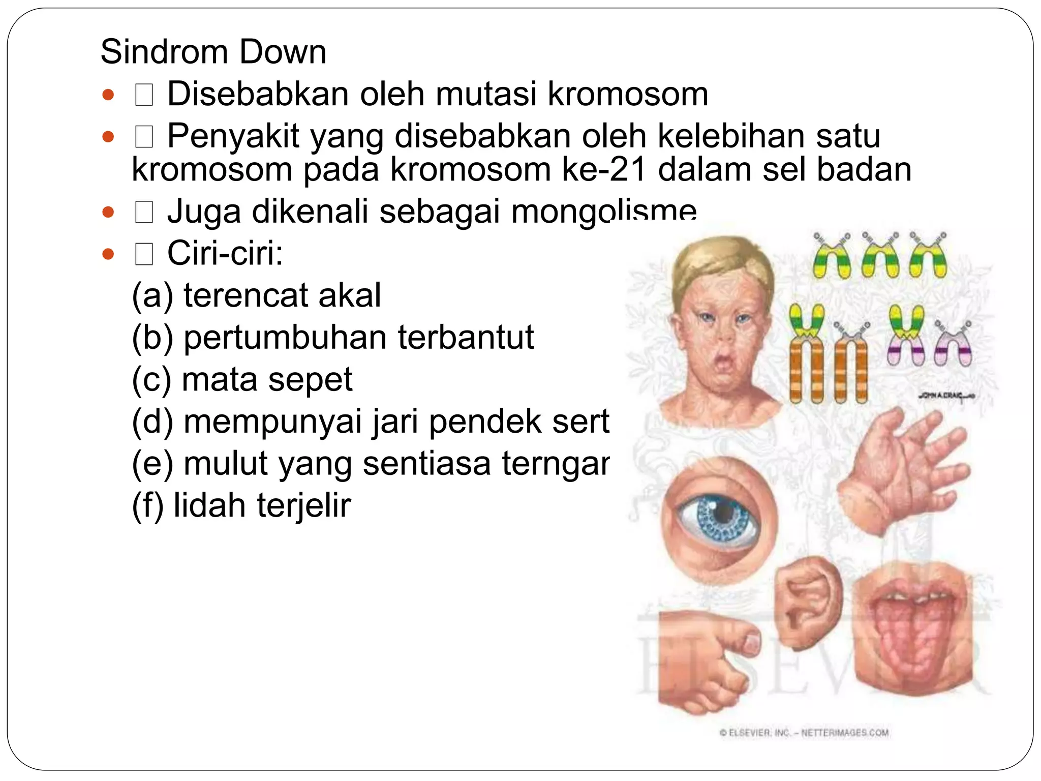Sindrom Down
 Disebabkan oleh mutasi kromosom
 Penyakit yang disebabkan oleh kelebihan satu
kromosom pada kromosom ke-21 dalam sel badan
 Juga dikenali sebagai mongolisme
 Ciri-ciri:
(a) terencat akal
(b) pertumbuhan terbantut
(c) mata sepet
(d) mempunyai jari pendek serta kecil
(e) mulut yang sentiasa ternganga
(f) lidah terjelir
 