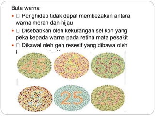 Buta warna
 Penghidap tidak dapat membezakan antara
warna merah dan hijau
 Disebabkan oleh kekurangan sel kon yang
peka kepada warna pada retina mata pesakit
 Dikawal oleh gen resesif yang dibawa oleh
kromosom seks X
 
