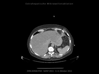 ZIRN.KHNW.FFM · SAINT 2011 · 3.-4. Oktober 2011
E x t r a h e p a t i s c h e M i k r o w e l l e n a b l a t i o n
 