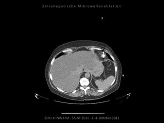 ZIRN.KHNW.FFM · SAINT 2011 · 3.-4. Oktober 2011
E x t r a h e p a t i s c h e M i k r o w e l l e n a b l a t i o n
 