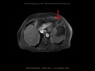 ZIRN.KHNW.FFM · SAINT 2011 · 3.-4. Oktober 2011
E x t r a h e p a t i s c h e M i k r o w e l l e n a b l a t i o n
 