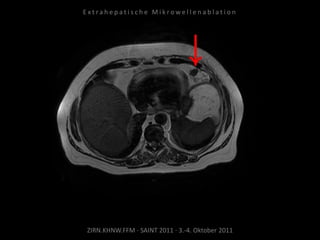 ZIRN.KHNW.FFM · SAINT 2011 · 3.-4. Oktober 2011
E x t r a h e p a t i s c h e M i k r o w e l l e n a b l a t i o n
 