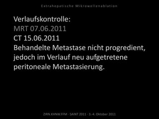 Verlaufskontrolle:
MRT 07.06.2011
CT 15.06.2011
Behandelte Metastase nicht progredient,
jedoch im Verlauf neu aufgetretene
peritoneale Metastasierung.
ZIRN.KHNW.FFM · SAINT 2011 · 3.-4. Oktober 2011
E x t r a h e p a t i s c h e M i k r o w e l l e n a b l a t i o n
 