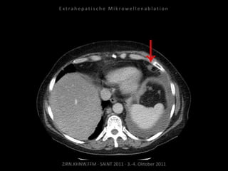 ZIRN.KHNW.FFM · SAINT 2011 · 3.-4. Oktober 2011
E x t r a h e p a t i s c h e M i k r o w e l l e n a b l a t i o n
 