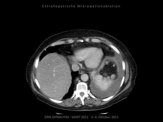 ZIRN.KHNW.FFM · SAINT 2011 · 3.-4. Oktober 2011
E x t r a h e p a t i s c h e M i k r o w e l l e n a b l a t i o n
 