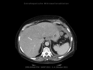 ZIRN.KHNW.FFM · SAINT 2011 · 3.-4. Oktober 2011
E x t r a h e p a t i s c h e M i k r o w e l l e n a b l a t i o n
 