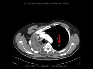 ZIRN.KHNW.FFM · SAINT 2011 · 3.-4. Oktober 2011
E x t r a h e p a t i s c h e M i k r o w e l l e n a b l a t i o n
 