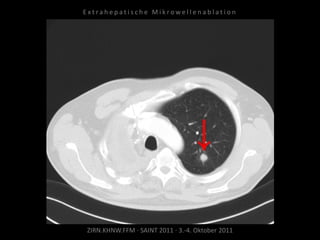 ZIRN.KHNW.FFM · SAINT 2011 · 3.-4. Oktober 2011
E x t r a h e p a t i s c h e M i k r o w e l l e n a b l a t i o n
 