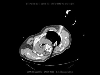 ZIRN.KHNW.FFM · SAINT 2011 · 3.-4. Oktober 2011
E x t r a h e p a t i s c h e M i k r o w e l l e n a b l a t i o n
 