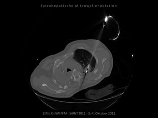 ZIRN.KHNW.FFM · SAINT 2011 · 3.-4. Oktober 2011
E x t r a h e p a t i s c h e M i k r o w e l l e n a b l a t i o n
 