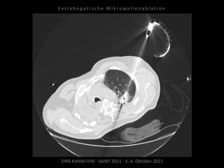 ZIRN.KHNW.FFM · SAINT 2011 · 3.-4. Oktober 2011
E x t r a h e p a t i s c h e M i k r o w e l l e n a b l a t i o n
 