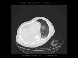 ZIRN.KHNW.FFM · SAINT 2011 · 3.-4. Oktober 2011
E x t r a h e p a t i s c h e M i k r o w e l l e n a b l a t i o n
 