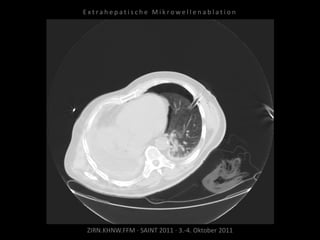 ZIRN.KHNW.FFM · SAINT 2011 · 3.-4. Oktober 2011
E x t r a h e p a t i s c h e M i k r o w e l l e n a b l a t i o n
 
