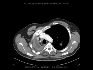 ZIRN.KHNW.FFM · SAINT 2011 · 3.-4. Oktober 2011
E x t r a h e p a t i s c h e M i k r o w e l l e n a b l a t i o n
 