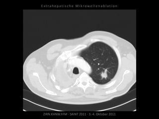 ZIRN.KHNW.FFM · SAINT 2011 · 3.-4. Oktober 2011
E x t r a h e p a t i s c h e M i k r o w e l l e n a b l a t i o n
 