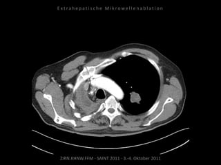 ZIRN.KHNW.FFM · SAINT 2011 · 3.-4. Oktober 2011
E x t r a h e p a t i s c h e M i k r o w e l l e n a b l a t i o n
 
