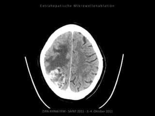 ZIRN.KHNW.FFM · SAINT 2011 · 3.-4. Oktober 2011
E x t r a h e p a t i s c h e M i k r o w e l l e n a b l a t i o n
 