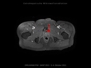 ZIRN.KHNW.FFM · SAINT 2011 · 3.-4. Oktober 2011
E x t r a h e p a t i s c h e M i k r o w e l l e n a b l a t i o n
 