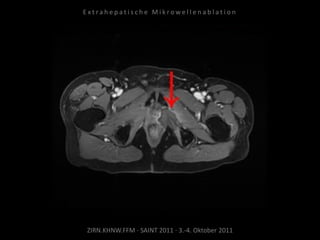 ZIRN.KHNW.FFM · SAINT 2011 · 3.-4. Oktober 2011
E x t r a h e p a t i s c h e M i k r o w e l l e n a b l a t i o n
 