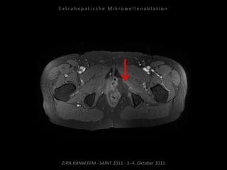 ZIRN.KHNW.FFM · SAINT 2011 · 3.-4. Oktober 2011
E x t r a h e p a t i s c h e M i k r o w e l l e n a b l a t i o n
 