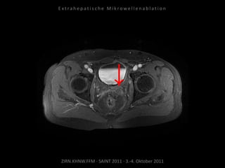 ZIRN.KHNW.FFM · SAINT 2011 · 3.-4. Oktober 2011
E x t r a h e p a t i s c h e M i k r o w e l l e n a b l a t i o n
 