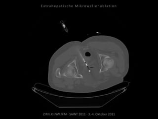 ZIRN.KHNW.FFM · SAINT 2011 · 3.-4. Oktober 2011
E x t r a h e p a t i s c h e M i k r o w e l l e n a b l a t i o n
 