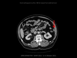 ZIRN.KHNW.FFM · SAINT 2011 · 3.-4. Oktober 2011
E x t r a h e p a t i s c h e M i k r o w e l l e n a b l a t i o n
 