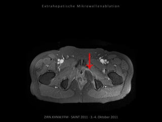 ZIRN.KHNW.FFM · SAINT 2011 · 3.-4. Oktober 2011
E x t r a h e p a t i s c h e M i k r o w e l l e n a b l a t i o n
 